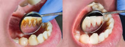 ¿qué Es Y Cómo Te Afecta El Biofilm Dental Clínica Dental Tiiz