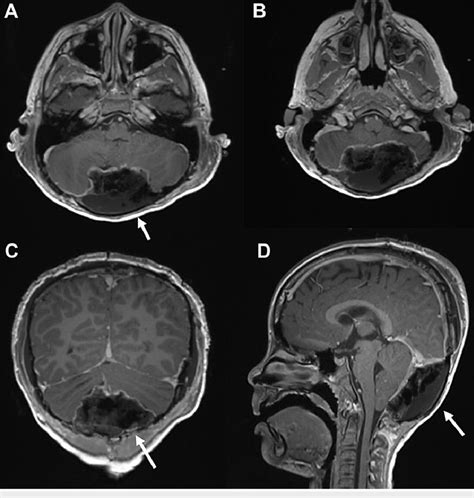 Postoperative Magnetic Resonance Imaging Demonstrating Gross Total