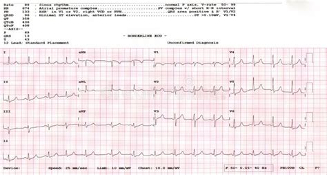 Cardiogram Waveform From An Ekg Showing Abnormal Ekg Test A Patient