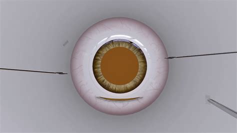 X NIT Extra Ocular Needle Guided Haptic Insertion Technique For