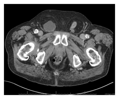 Axial View Of Bladder Hernia In Right Inguinal Canal And Colon In Left