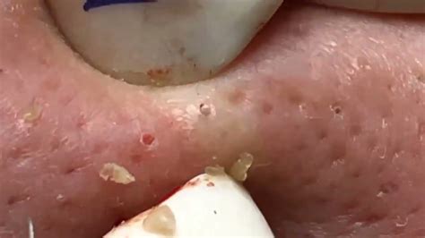 Pimple Popping Videos Blackheads Removal Youtube Ayla Harper