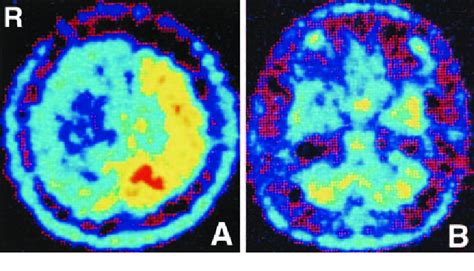 C Methionine Positron Emission Tomography Scans Showing A