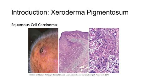 Xeroderma Pigmentosum Histology