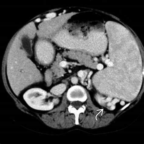 Splenomegaly And Hypersplenism Radiology Key