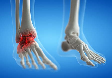 Arthritis of the foot and ankle | Orthopaedics WA