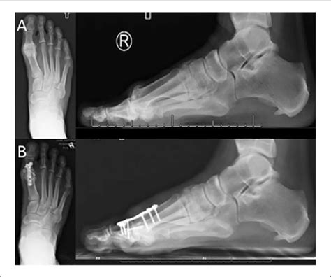 First Metatarsophalangeal Joint Arthrodesis A Significant Sclerosis Download Scientific