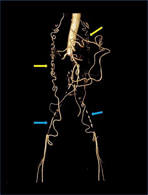 Leriche Syndrome The Three Dimensional CT Rendering Technique VRT