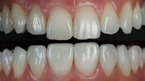 Pros And Cons Of Composite Bonding | Smile Stories