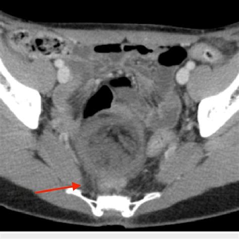 Axial View Of The Ct Abdomen Pelvis Showing The Complex Mass Red Arrow Download Scientific