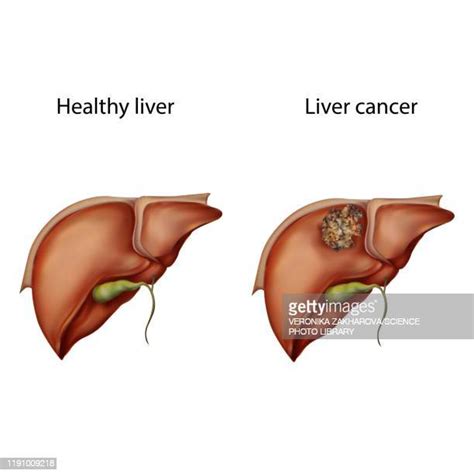 Liver Tumor Stock Fotos Und Bilder Getty Images