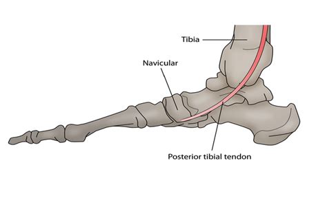 Posterior Tibial Tendon Dysfunction PTTD Hurst Podiatry