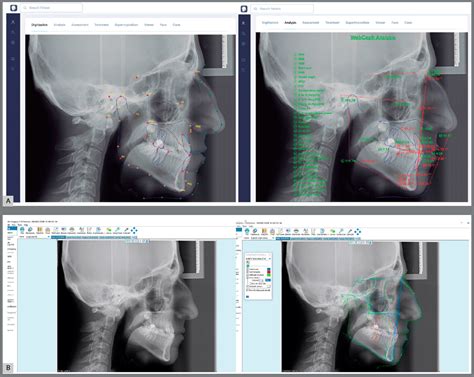 Scielo Brasil Comparison Between Cephalometric Measurements Using