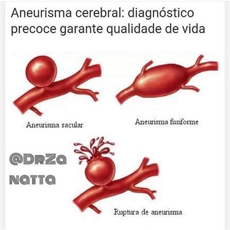 O Que Um Aneurisma Cerebral Blog Do Fidelis