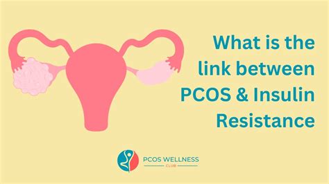 Link Between Insulin Resistance And Pcos What You Need To Know Youtube