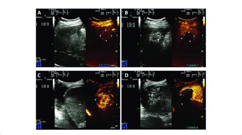 Contrast Enhanced Ultrasound CEUS Of One Patient With HCC A B