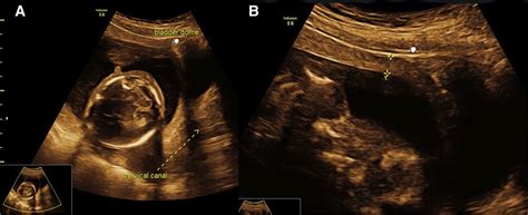 Correlation between lower uterine wall thickness measured by ...