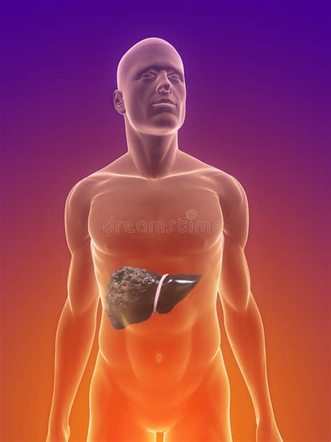 Liver Cancer Stock Illustration Illustration Of Male 14143184