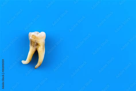 Fotka „a Real Human Tooth Is Affected By Caries And With A Curved Root