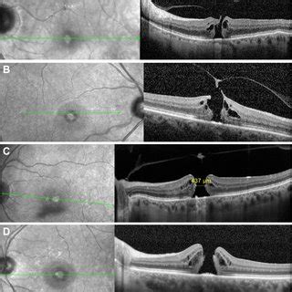 Pdf Optimal Management Of Idiopathic Macular Holes