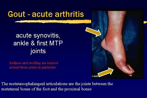 Drug Therapy Of Gout What Is Gout A