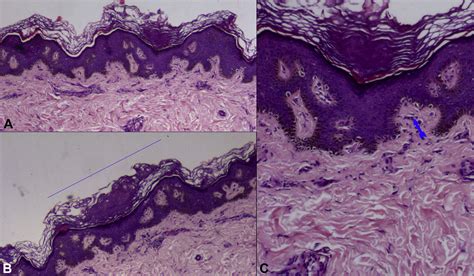 Dermoscopy Of Acrokeratosis Verruciformis Of Hopf Journal Of The