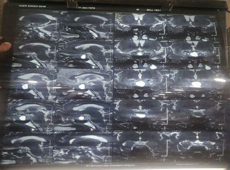 T2 weighted sagittal section of mri brain showing pituitary apoplexy ...