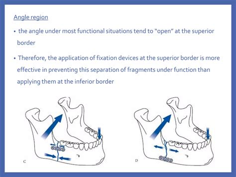 fixation systems  maxillofacial fractures pptx