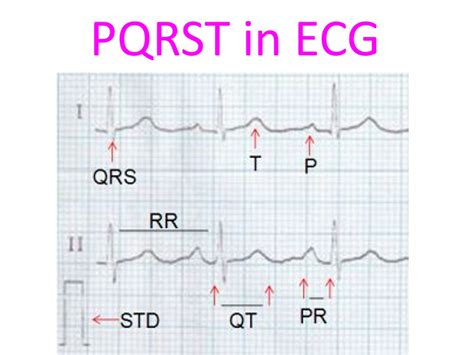 ECG Waveform Explained: EKG Labeled Diagrams And Components, 49% OFF