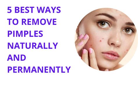 5 Best Ways To Remove Pimples Naturally And Permanently