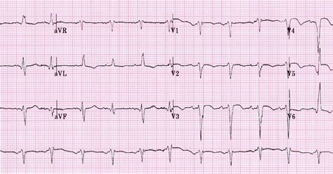 Left Ventricular Aneurysm Ecg