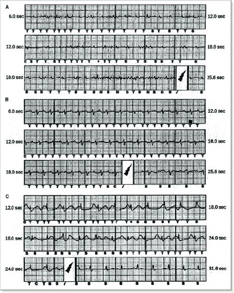 Surface Ecg Racing Of Inappropriate Subcutaneous Implantable