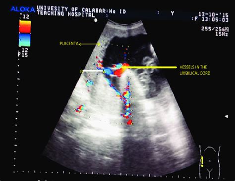 Color Flow Doppler Image Showing The Placental Thickness Measurement