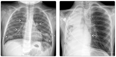 Chest X Ray Asthma