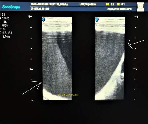 Case 07: Retroperitoneal Hematoma Ultrasound ~ Imaging Study