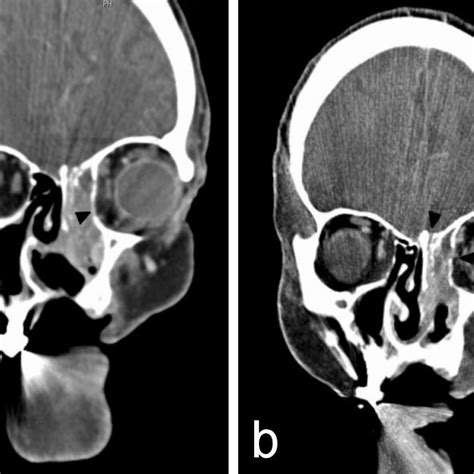 Nasal cavity and paranasal sinuses CT scan. Axial cross-section ...