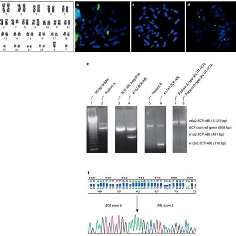 The Diagram Of Several Bcr Abl Fusion Transcripts And Their Frequency