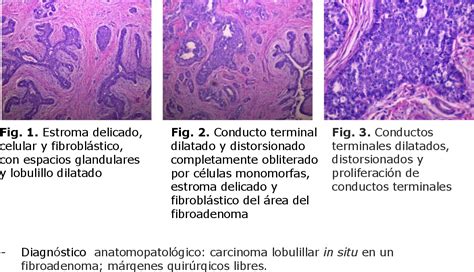 Figure From Carcinoma Lobulillar In Situ En Una Paciente Con