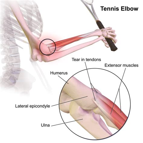 Tennis Elbow Fairview Physiotherapy Rehab Centre