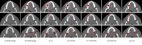 Figure From Deep Sinogram Completion With Image Prior For Metal