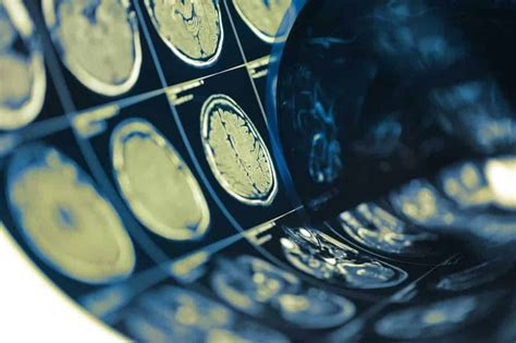 Estudo Publicado Na Revista The Lancet Neurology Revela Que Mudan As