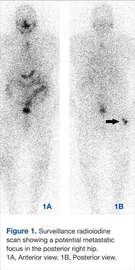 Radioactive Iodine Scintiphotos Of A Man With Thyroid Cancer Avaho