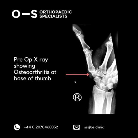 Joint Replacement Of Right First Carpometacarpal Joint Of The Thumb For Osteoarthritis