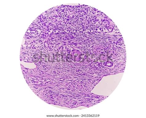 Histology Peritoneal Inclusion Cyst Paraovarian Cysts Stock Photo ...