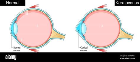 Keratoconus Eye Disorder Corneal Thinning Progressive Eye Disease