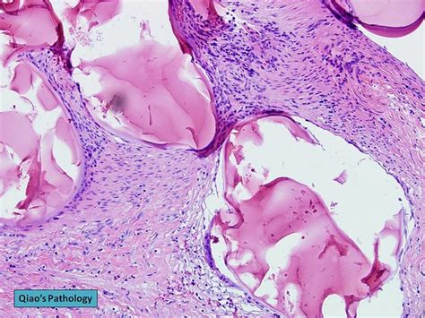 Qiaos Pathology Uterine Artery Embolization Of Leiomyoma Fibroid