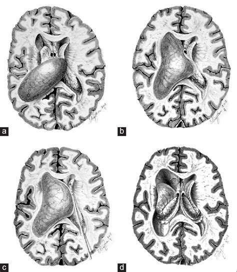 Surgical Neurology International