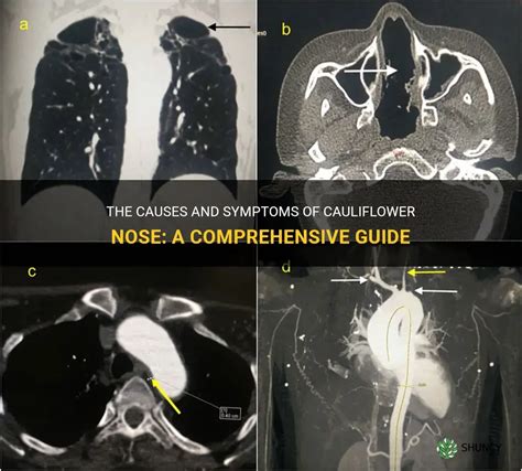 The Causes And Symptoms Of Cauliflower Nose A Comprehensive Guide Shuncy