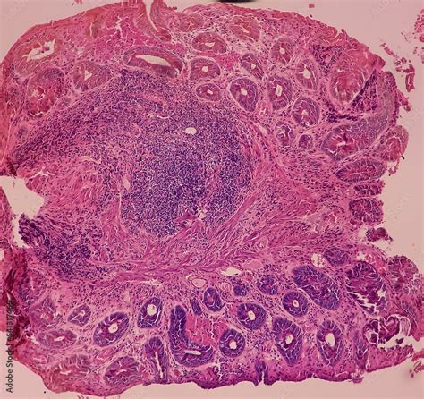 Anal Canal Ulcer Biopsy Chronic Nonspecific Proctitis Show Anal Mucosa Dense Infiltration Of