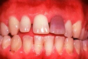 Teeth Stains And Discolorations Causes And How To Fix Them